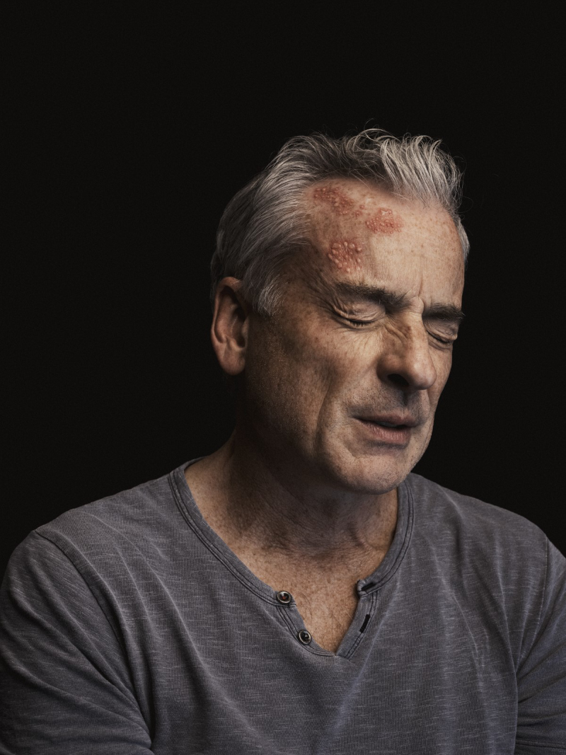 Los 7 mitos más comunes del Herpes Zóster